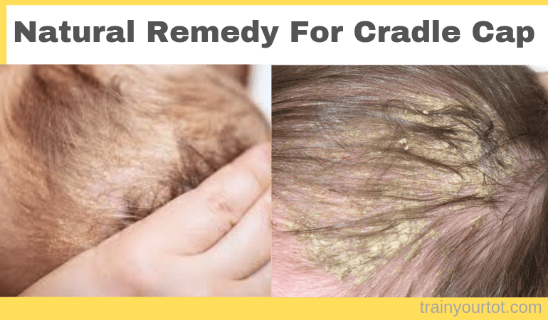 Natural Remedy for Cradle Cap
